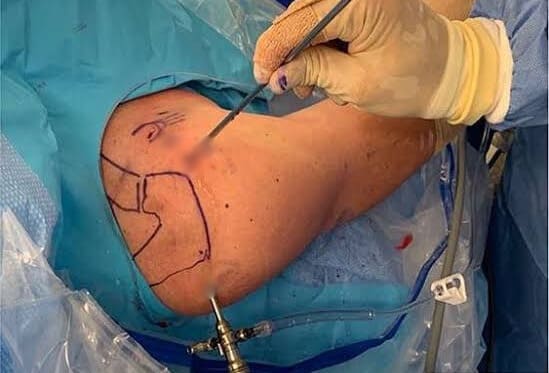 Artroscopia de hombro