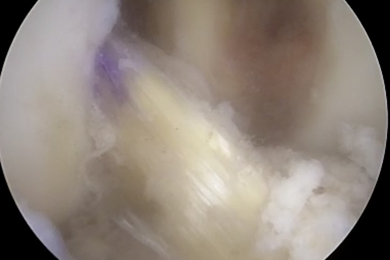 Reconstrucción de ligamento cruzado anterior